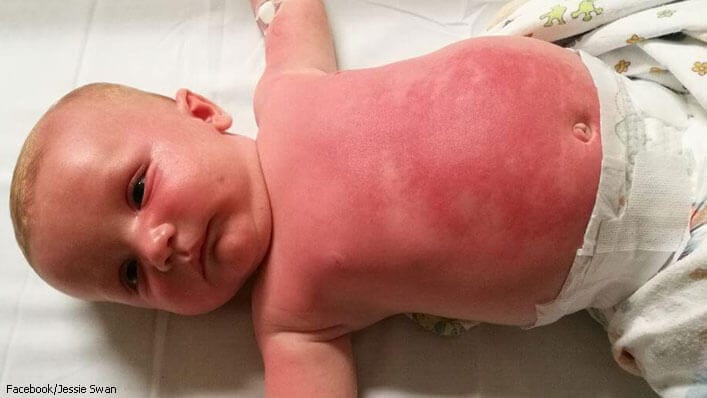 Mom Urges "Do NOT Buy This Sunscreen" After 3-Month-Old Is Hospitalized for 3 Days From Burns
