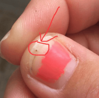 ticks